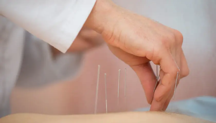 Dłoń terapeuty umieszcza igły do akupunktury na skórze pacjenta.